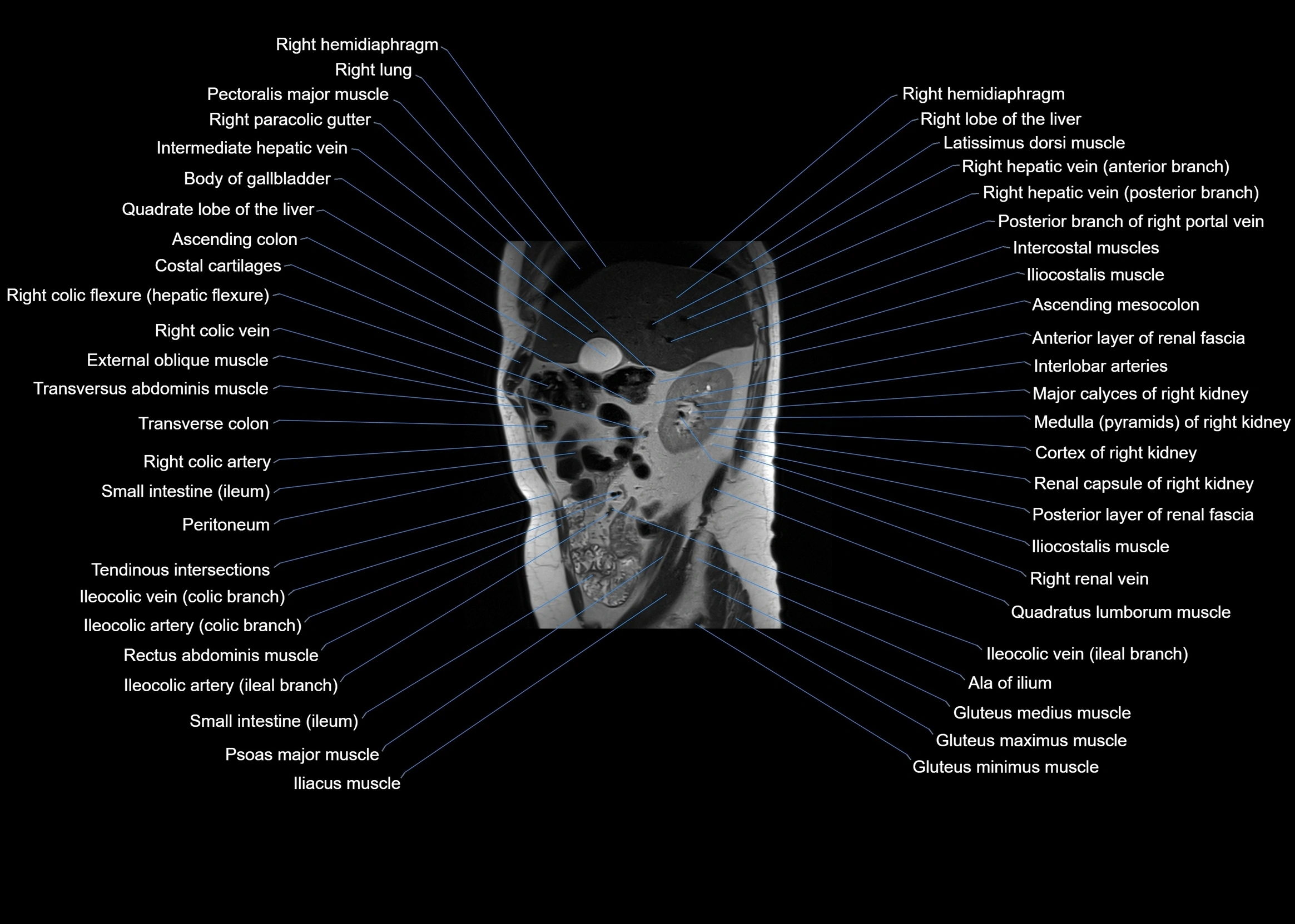 MRI abdomen sagittal cross sectional anatomy  radiology  image-img-00001-00023.webp